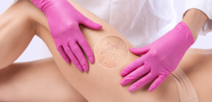 VARICOSE VEINS! How to remove them?