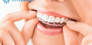 ¿CONOCES INVISALIGN?