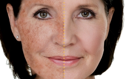 IPL TECHNOLOGY: LIGHT FOR YOUR FACE