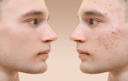 WHAT YOU SHOULD KNOW ABOUT ACNE