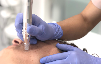 MICRONEEDLING with m.pen [PRO], the treatment that exercises your skin.