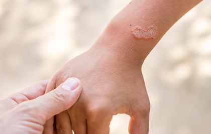 EXISTEIXEN DIFERENTS TIPUS DE PSORIASI. SAPS QUINS SÓN?