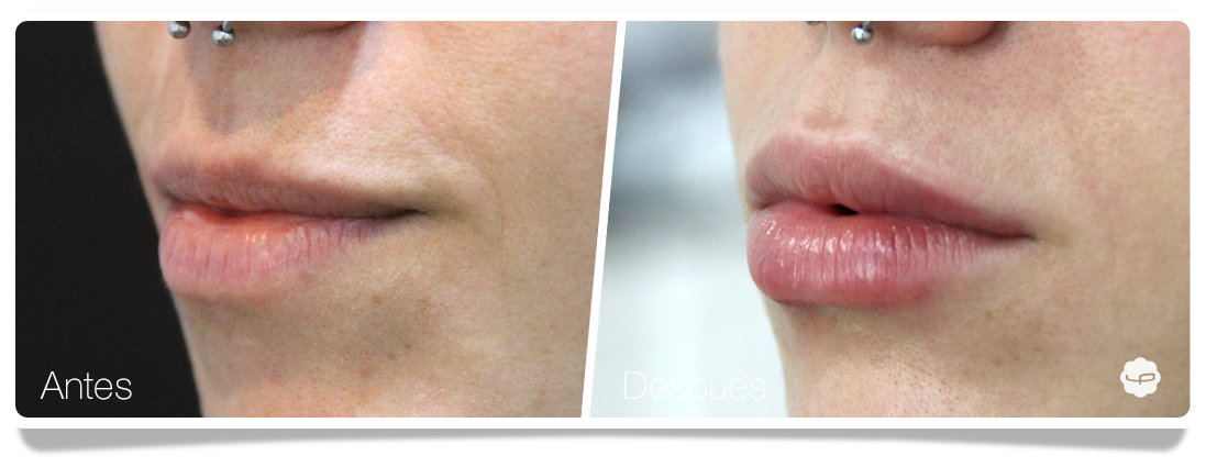 Clinica-Aureo-Aumento-de-labios-Antes-despues-05-ES.png