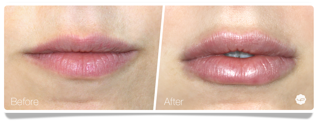 Clinica-Aureo-Lip-Augmentation-Before-After-10-EN.png
