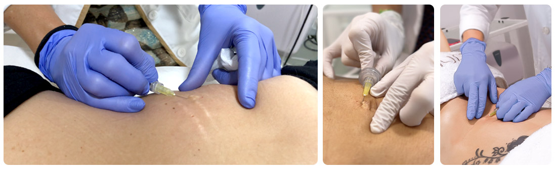 Carboxiterapia