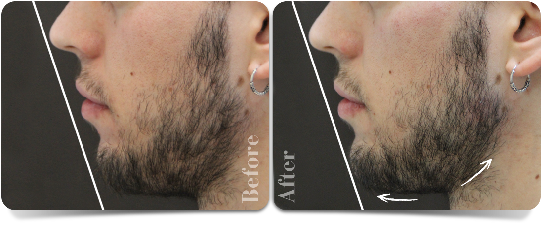 chin-augmentation-left-profile-clinic-aureo-en.png
