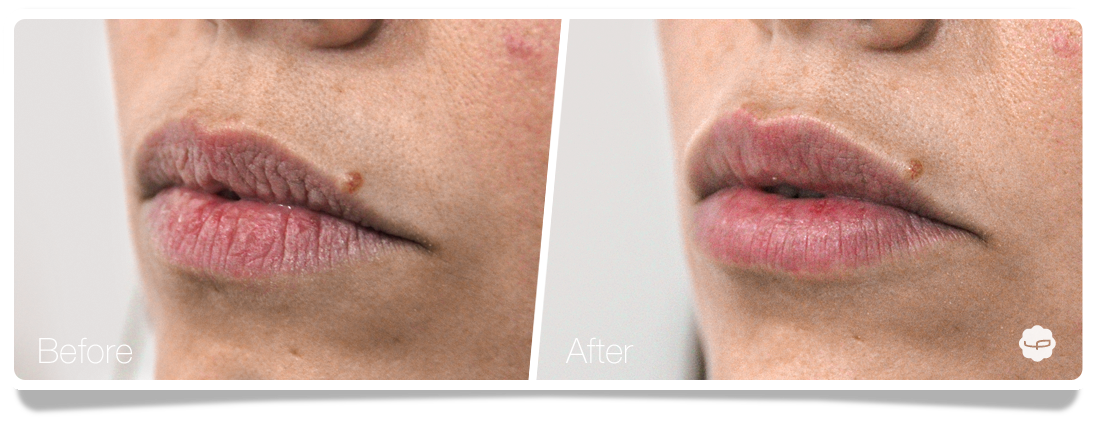 Clinica-Aureo-Lip-Augmentation-Before-After-02-EN.png