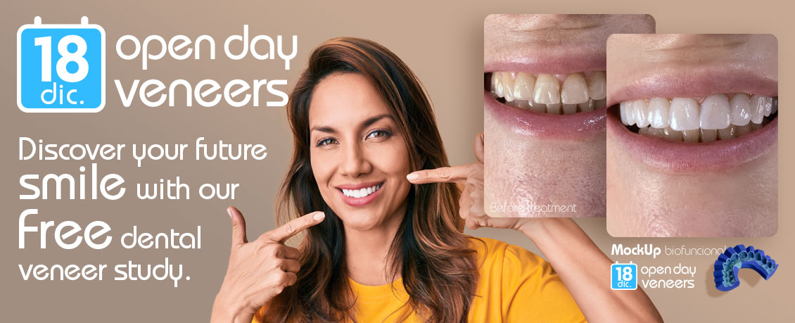 OPEN DAY VENEERS