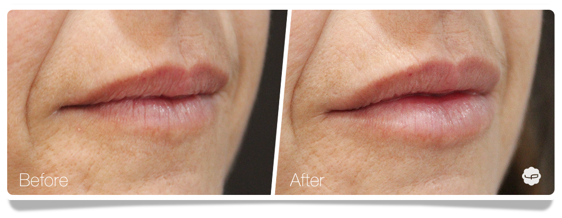 Clinica-Aureo-Lip-Augmentation-Before-After-08-EN.png