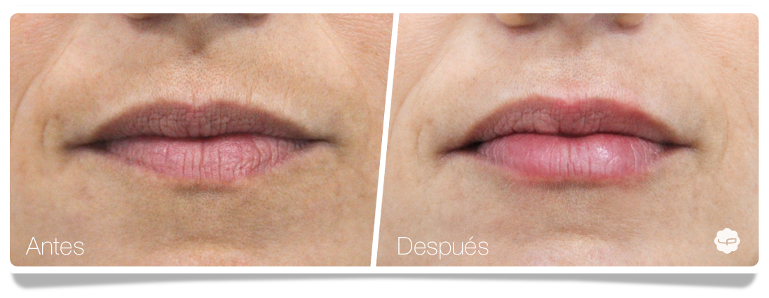 Clinica-Aureo-Aumento-de-labios-Antes-despues-09-ES.png