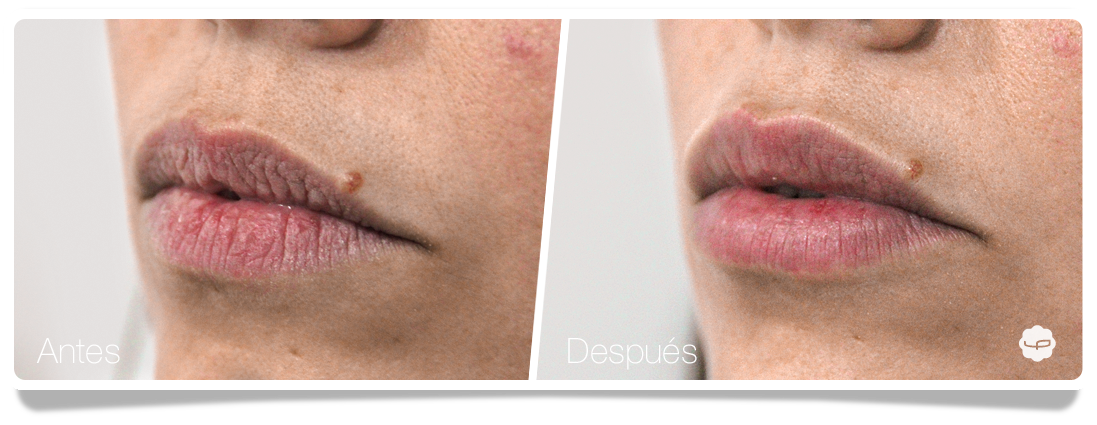 Clinica-Aureo-Aumento-de-labios-Antes-despues-02-ES.png