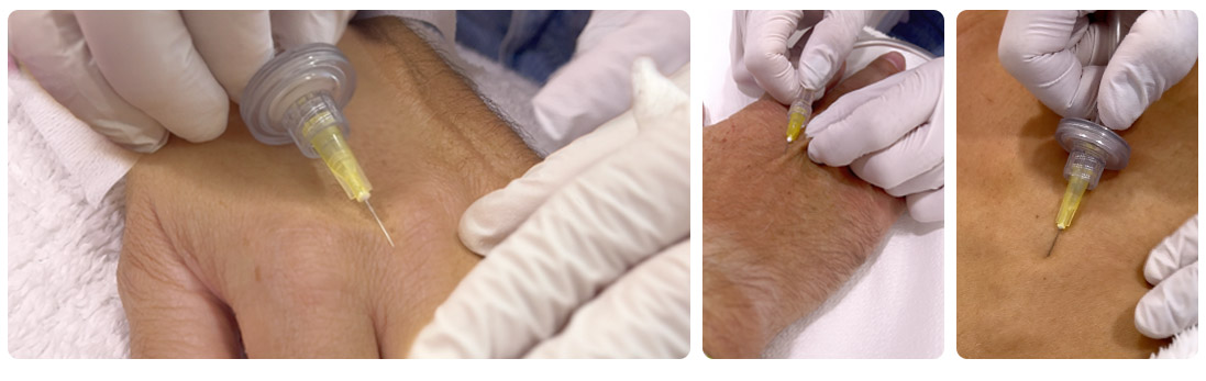 Carboxiterapia mans