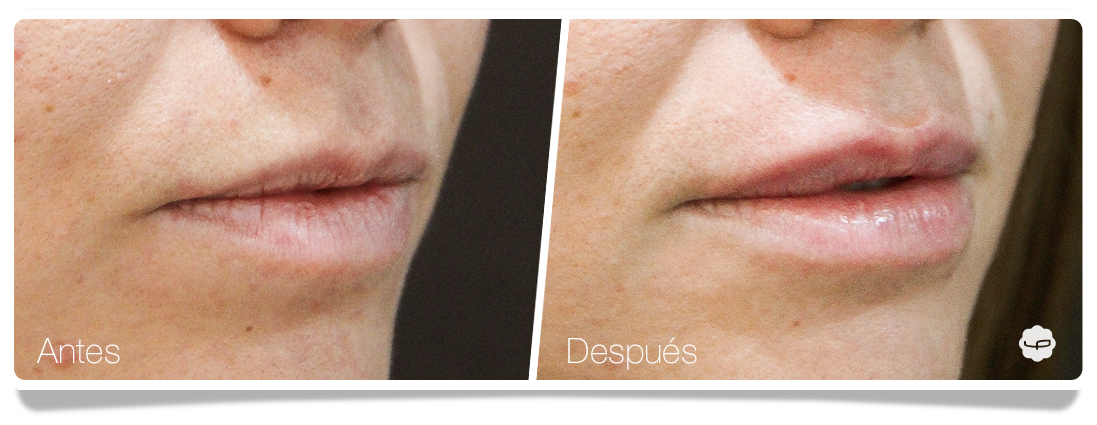 Clinica-Aureo-Aumento-de-labios-Antes-despues-13-ES.png