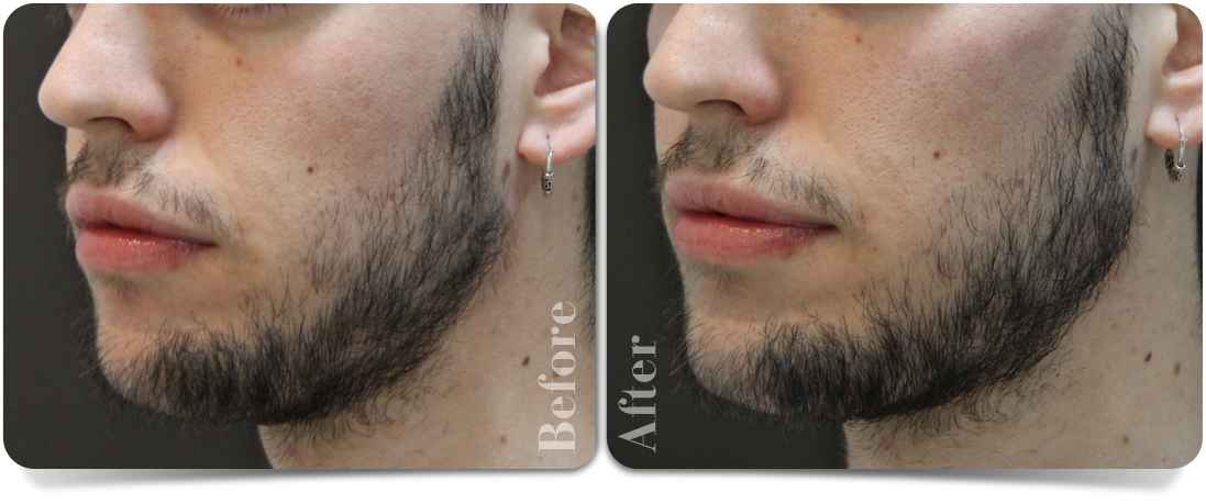 chin-augmentation-left-third-clinic-aureo-en.png