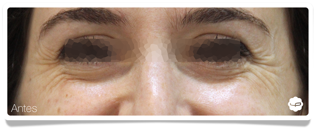 Clinica-Aureo-Patas-de-Gallo-Chica-Botox-Antes-Frontal-ES.png