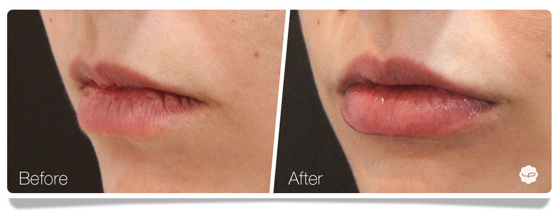 Clinica-Aureo-Lip-Augmentation-Before-After-04-EN.png
