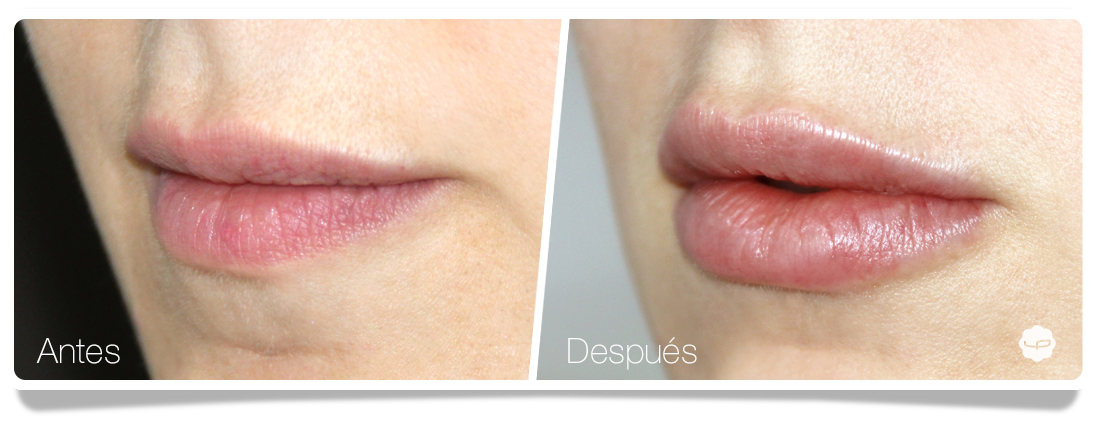 Clinica-Aureo-Aumento-de-labios-Antes-despues-11-ES.png