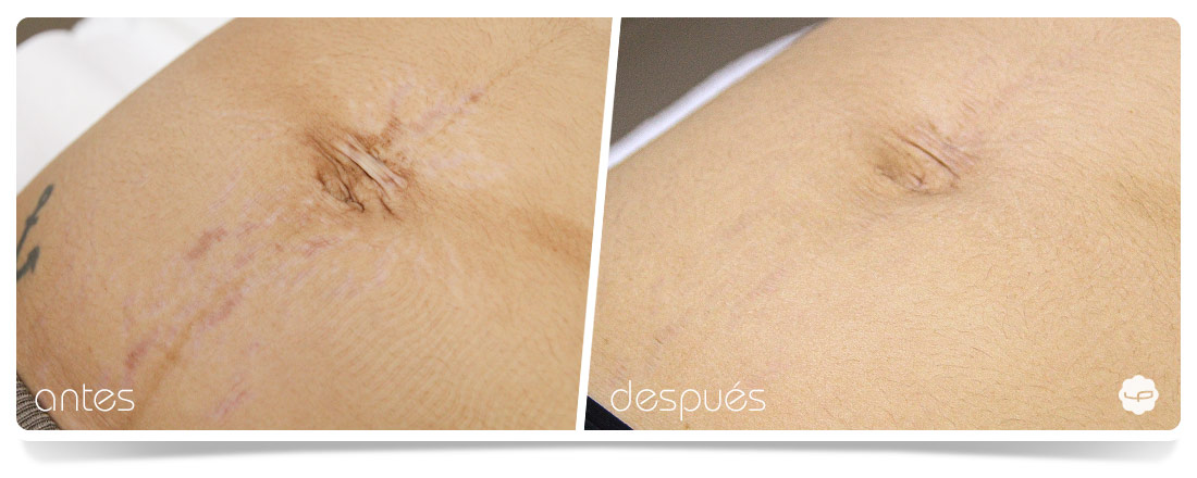 Antes y Después del tratamiento de estrías 02