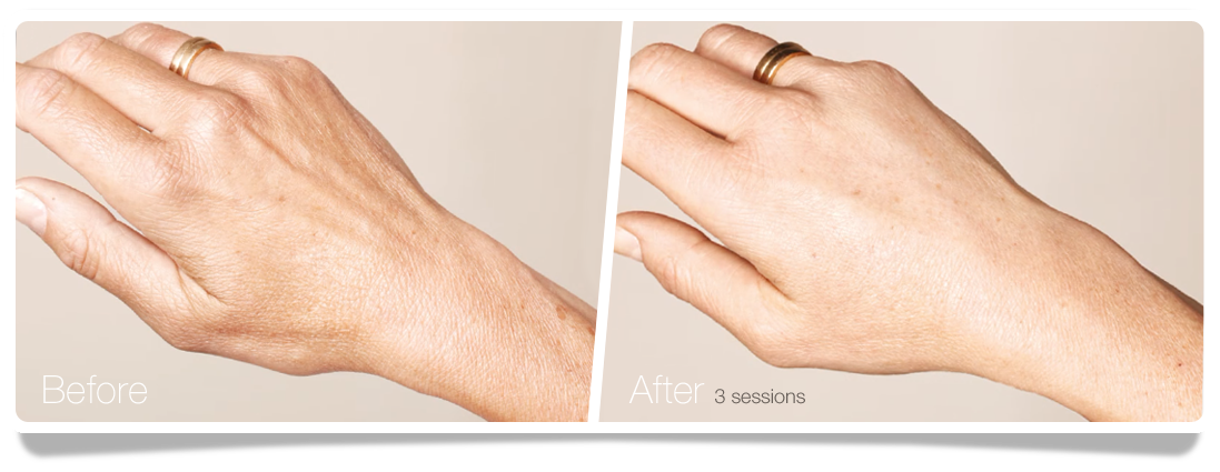 Clinica-Aureo-Hands-Skinbooster-Before-After-EN