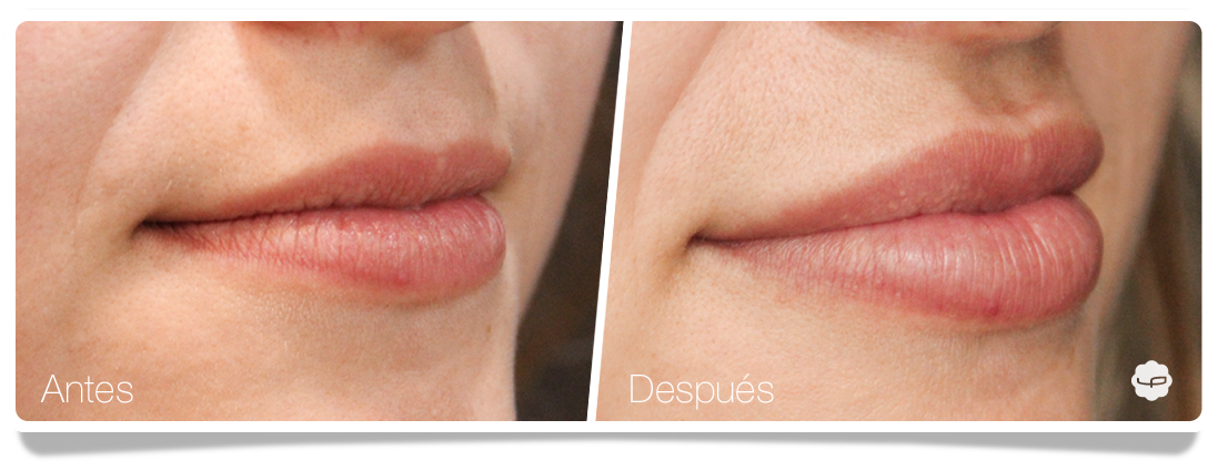 Clinica-Aureo-Aumento-de-labios-Antes-despues-01-ES.png
