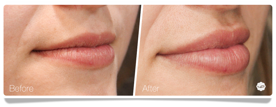 Clinica-Aureo-Lip-Augmentation-Before-After-01-EN.png