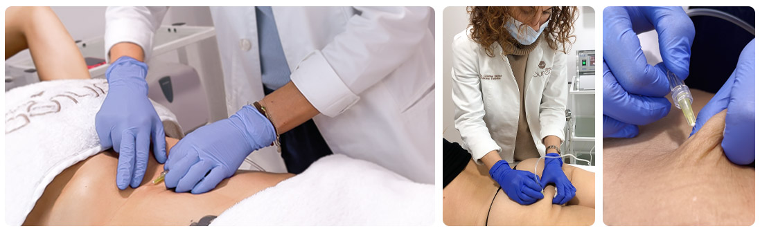 Carboxytherapy