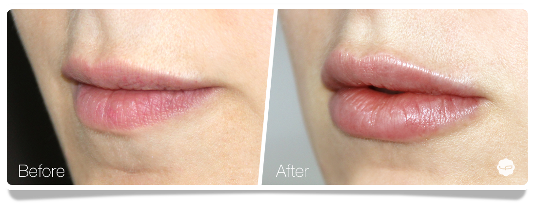 Clinica-Aureo-Lip-Augmentation-Before-After-11-EN.png