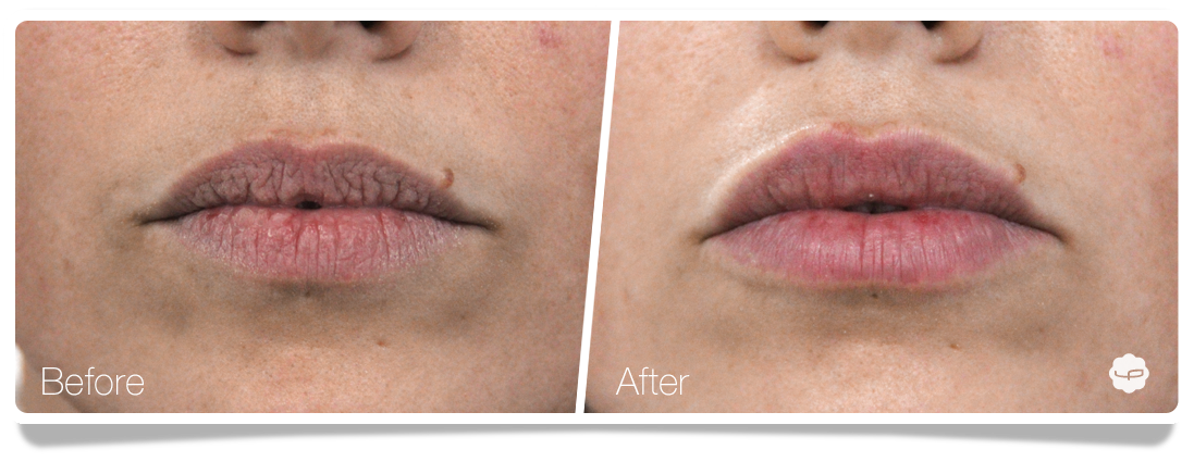 Clinica-Aureo-Lip-Augmentation-Before-After-03-EN.png