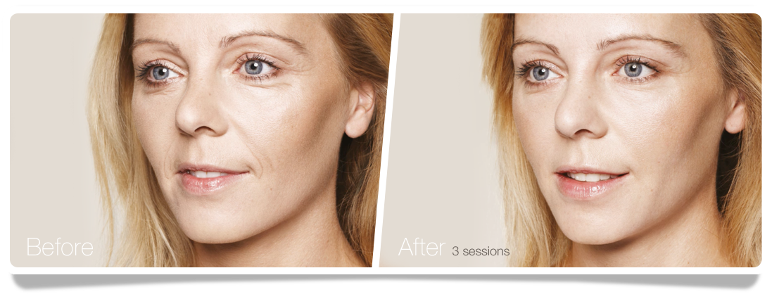 Clinica-Aureo-woman-Skinbooster-Before-After-EN