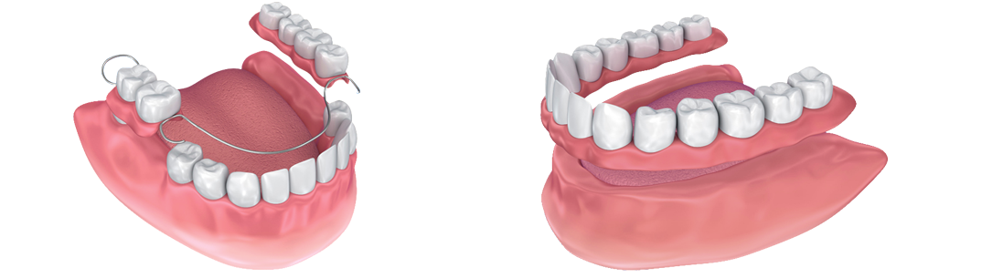 Clinica-Aureo-Protesis-Dentals-Removibles-metalica-completa-Mallorca.png