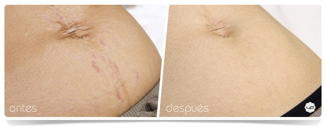 Antes y Después del tratamiento de estrías 01