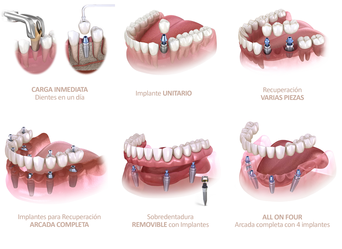 Clinica-Aureo-Implantes-Dentales-Variedad-Mallorca-ES.png