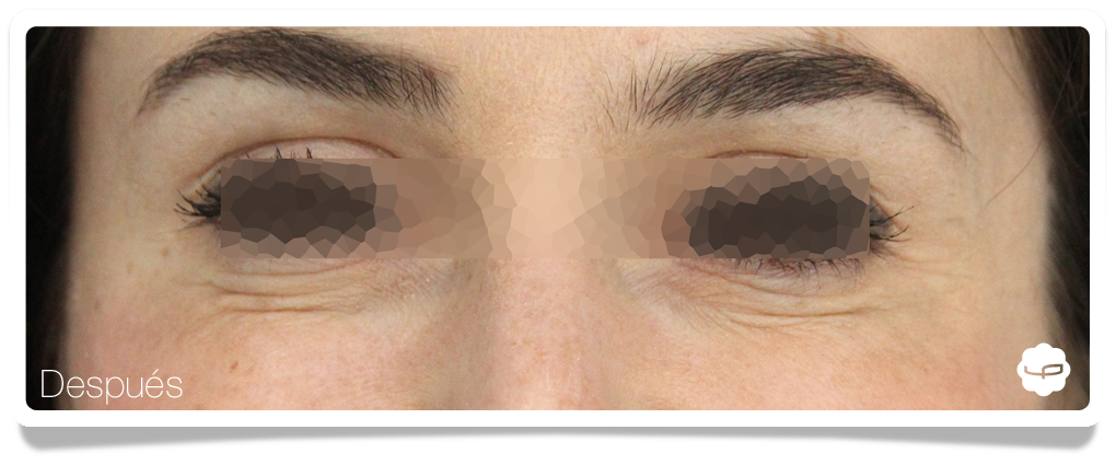 Clinica-Aureo-Patas-de-Gallo-Chica-Botox-Frontal-Despues-ES.png