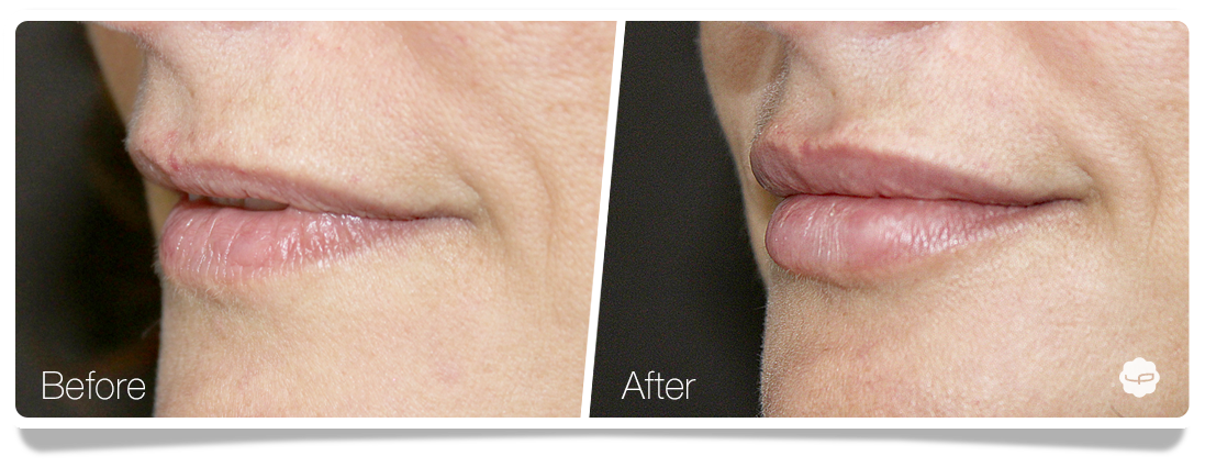 Clinica-Aureo-Lip-Augmentation-Before-After-06-EN.png