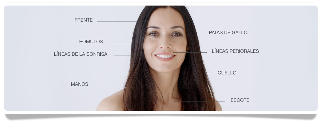 Zonas de aplicación de Skinbooster Restylane Vital