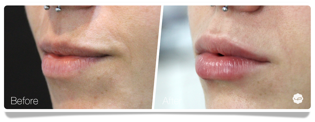 Clinica-Aureo-Lip-Augmentation-Before-After-05-EN.png