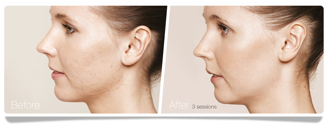 Clinica-Aureo-Acne-Skinbooster-Before-After-EN