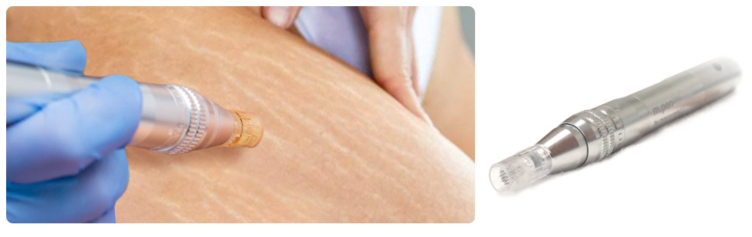 Microneedling Dermapen