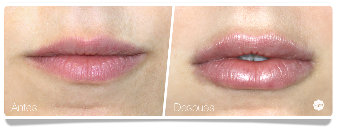 Clinica-Aureo-Aumento-de-labios-Antes-despues-10-ES.png