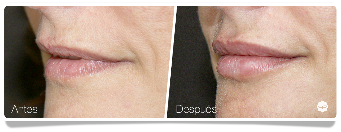 Clinica-Aureo-Aumento-de-labios-Antes-despues-06-ES.png
