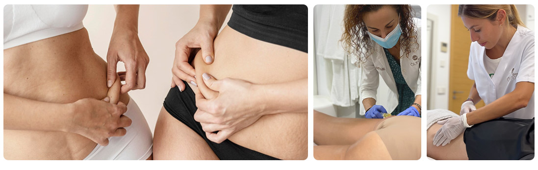 Body Mesotherapy