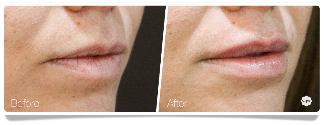 Clinica-Aureo-Lip-Augmentation-Before-After-13-EN.png