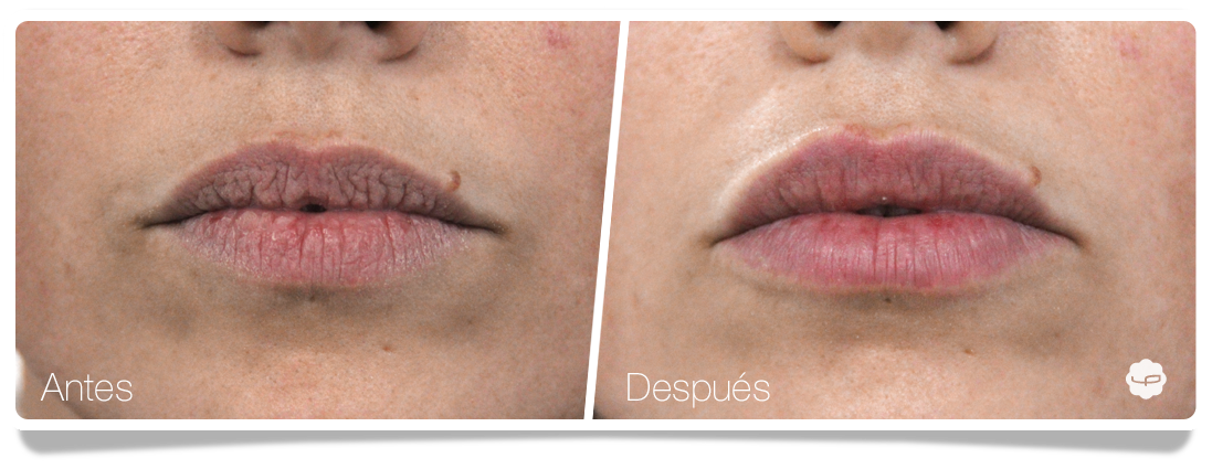 Clinica-Aureo-Aumento-de-labios-Antes-despues-03-ES.png