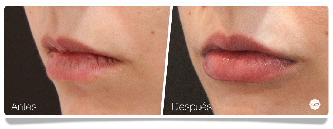 Clinica-Aureo-Aumento-de-labios-Antes-despues-04-ES.png