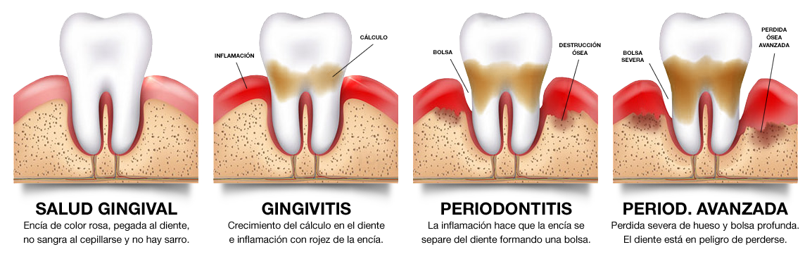 Periodontitis-Gingivitis-Pasos-Clinica-Aureo-Palma-de-Mallorca-ES