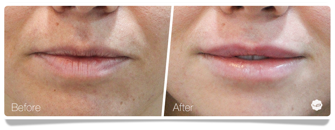 Clinica-Aureo-Lip-Augmentation-Before-After-12-EN.png
