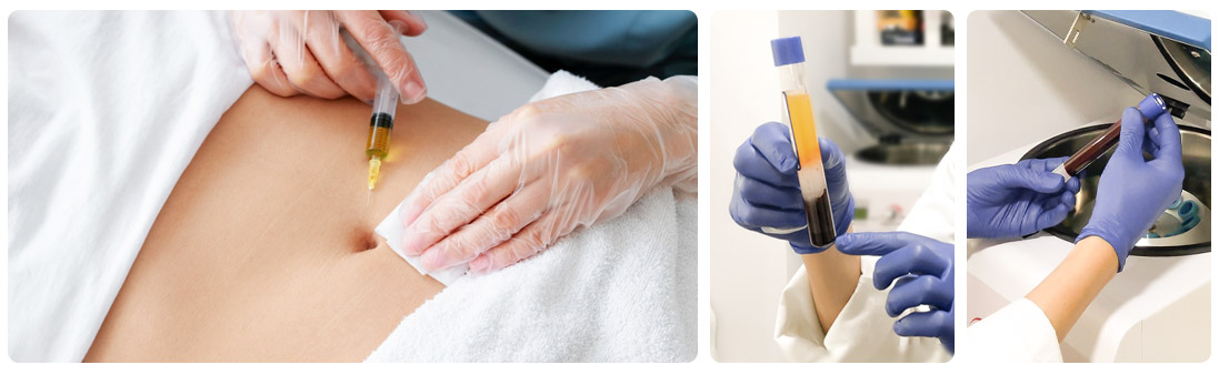 PRP Plasma Rico en Plaquetas