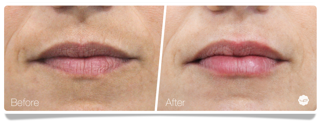 Clinica-Aureo-Lip-Augmentation-Before-After-09-EN.png