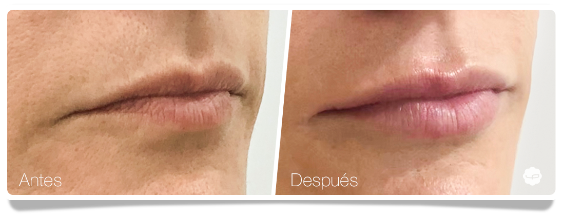 Clinica-Aureo-Aumento-de-labios-Antes-despues-15-ES.png