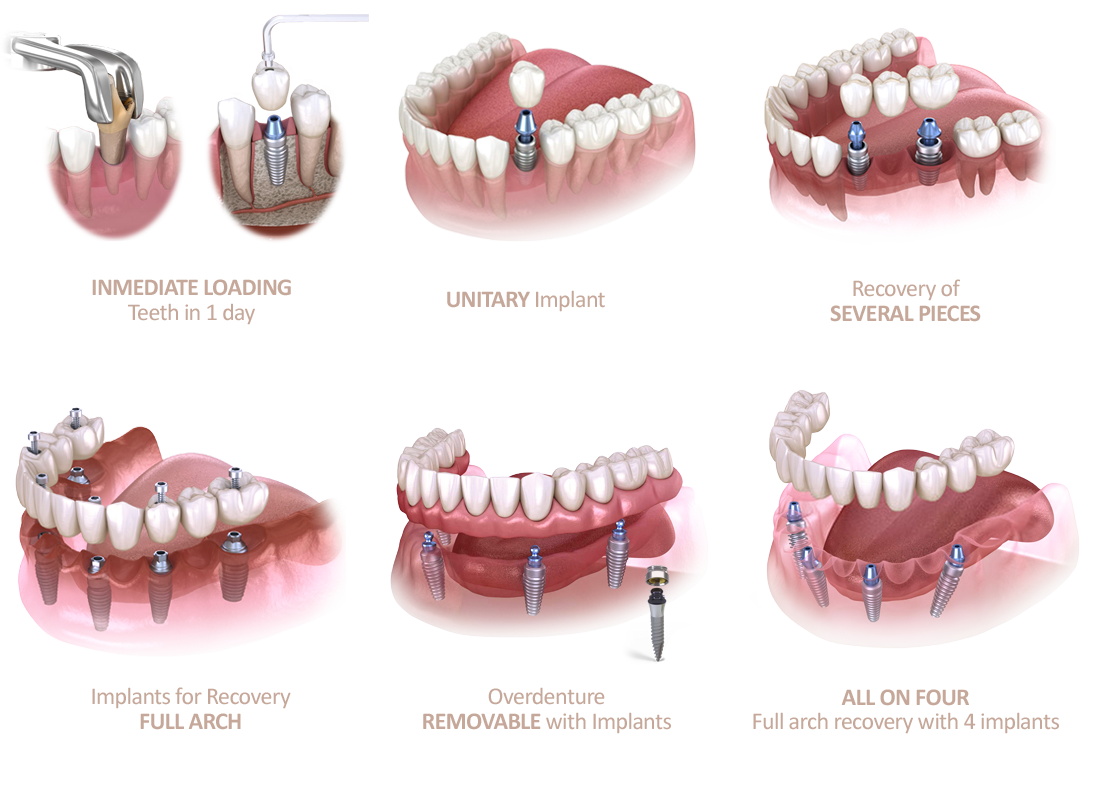 Clinica-Aureo-dental-implants-types-Mallorca-EN.png
